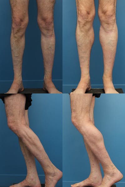Calf Augmentation Before and After | Ranch & Coast Plastic Surgery