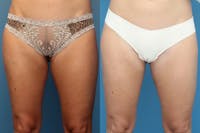 Coolsculpting Gallery - Patient 123065045 - Image 1