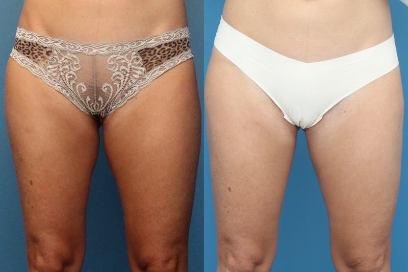 Coolsculpting Elite Before & After Gallery - Patient 123065045 - Image 1
