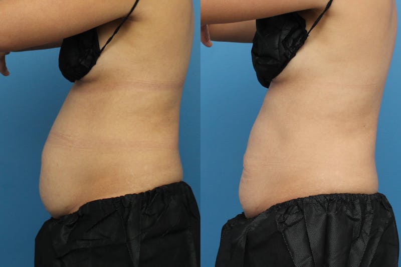 Coolsculpting Before & After Gallery - Patient 123173864 - Image 1