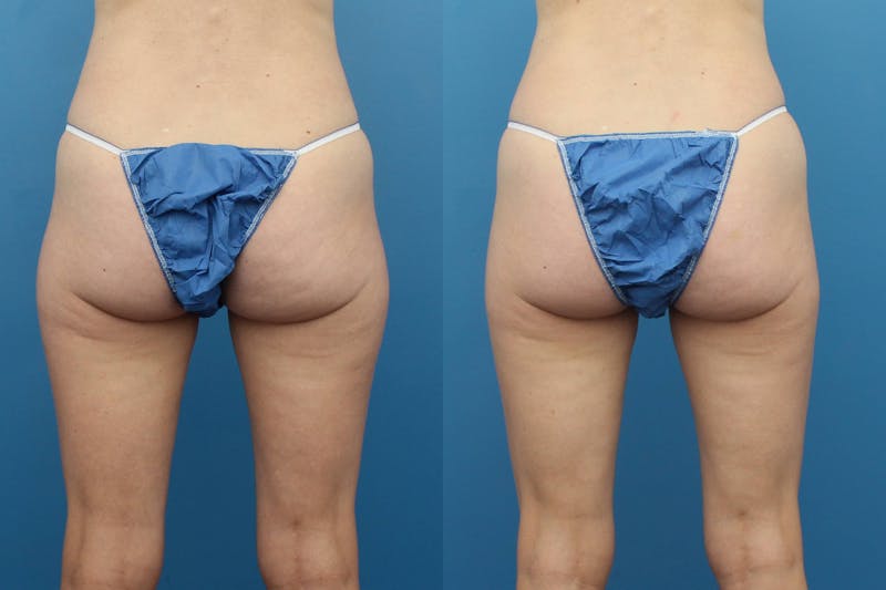 Coolsculpting Elite Before & After Gallery - Patient 123173860 - Image 1