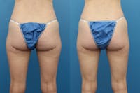 Coolsculpting Gallery - Patient 123173860 - Image 1