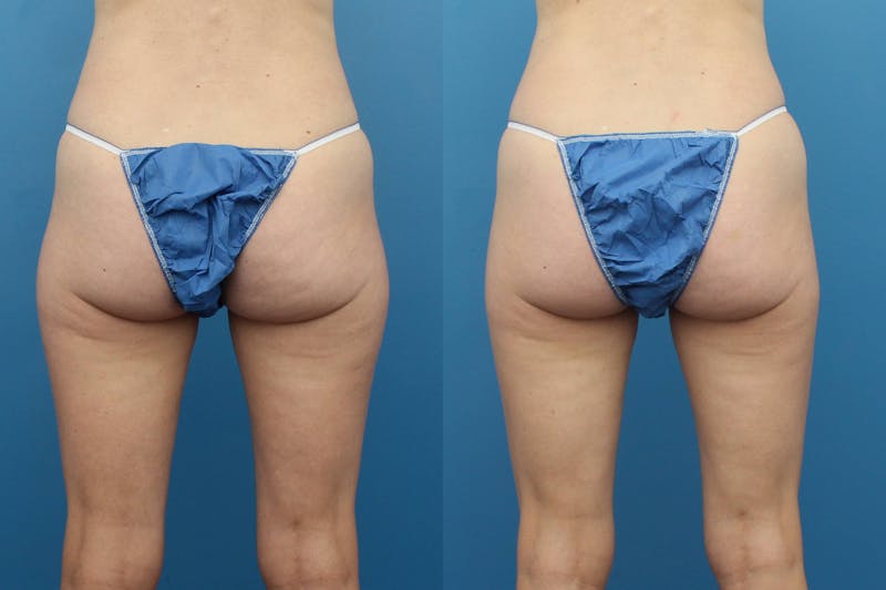 Coolsculpting Elite Before & After Gallery - Patient 123173860 - Image 1