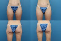 Coolsculpting Elite Before & After Gallery - Patient 123173859 - Image 1