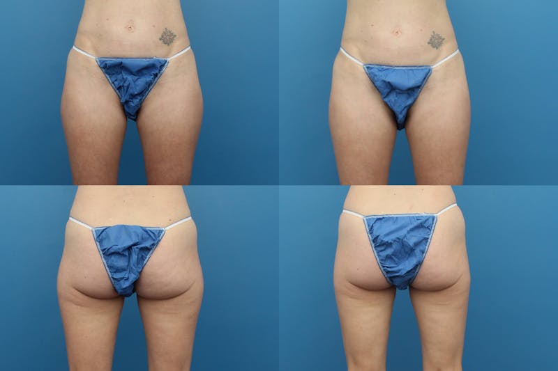 Coolsculpting Elite Before & After Gallery - Patient 123173859 - Image 1