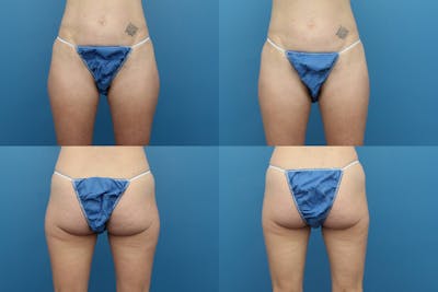 Coolsculpting Elite Before & After Gallery - Patient 123173859 - Image 1
