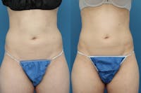 Coolsculpting Gallery - Patient 123173862 - Image 1