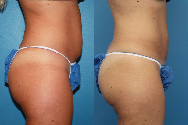 Coolsculpting Elite Before & After Gallery - Patient 123173863 - Image 1