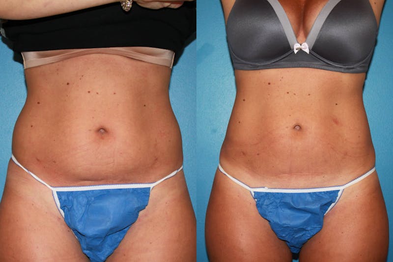 Coolsculpting Before & After Gallery - Patient 123173861 - Image 1