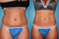 Coolsculpting Elite Before & After Gallery - Patient 123173861 - Image 1