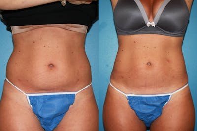 Coolsculpting Before & After Gallery - Patient 123173861 - Image 1