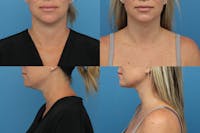 Coolsculpting Gallery - Patient 123173867 - Image 1