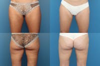Coolsculpting Before & After Gallery - Patient 123173858 - Image 1
