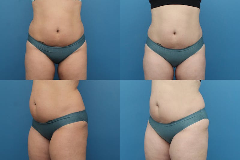 Coolsculpting Elite Before & After Gallery - Patient 123173857 - Image 1