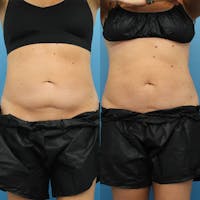 Coolsculpting Elite Before & After Gallery - Patient 123173866 - Image 1