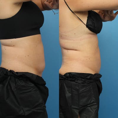Coolsculpting Elite Before & After Gallery - Patient 123173865 - Image 1
