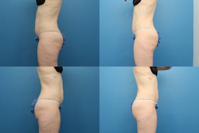 Coolsculpting Elite Before & After Gallery - Patient 123173856 - Image 1