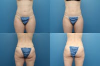 Coolsculpting Elite Before & After Gallery - Patient 123173855 - Image 1