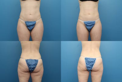 Coolsculpting Elite Before & After Gallery - Patient 123173855 - Image 1