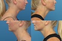 Coolsculpting Elite Before & After Gallery - Patient 123173868 - Image 1