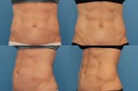 Coolsculpting Before & After Gallery - Patient 123173853 - Image 1