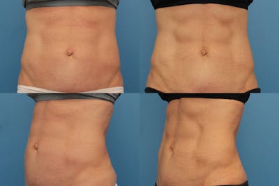 Coolsculpting Elite Before & After Gallery - Patient 123173853 - Image 1