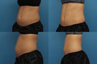 Coolsculpting Gallery - Patient 123173854 - Image 1
