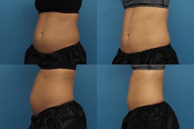 Coolsculpting Before & After Gallery - Patient 123173854 - Image 1