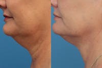 Coolsculpting Gallery - Patient 123173870 - Image 1