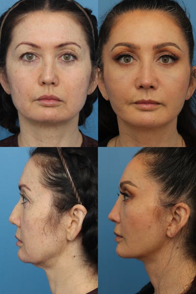 Crooked Nose Before & After Gallery - Patient 123887104 - Image 1