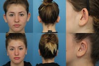 Dr. Chasan Otoplasty Before & After Gallery - Patient 140820759 - Image 1