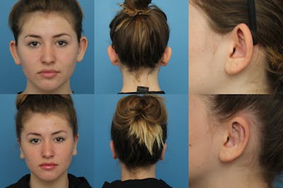 Dr. Chasan Otoplasty Before & After Gallery - Patient 140820759 - Image 1