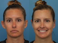 Dr. Francis Otoplasty Before & After Gallery - Patient 141068006 - Image 1