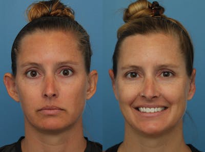 Dr. Francis Otoplasty Before & After Gallery - Patient 141068006 - Image 1
