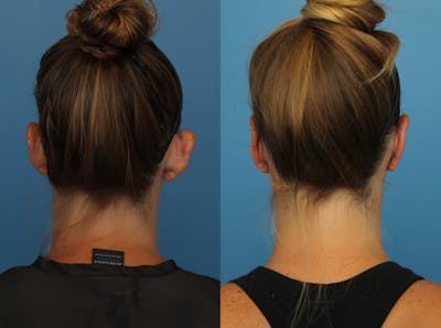 Dr. Francis Otoplasty Before & After Gallery - Patient 141068007 - Image 1