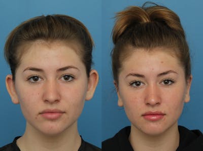 Dr. Francis Otoplasty Before & After Gallery - Patient 141068008 - Image 1
