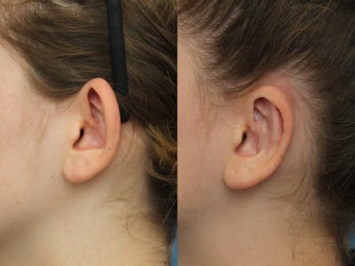 Dr. Francis Otoplasty Before & After Gallery - Patient 141112061 - Image 1