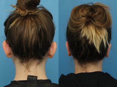 Dr. Francis Otoplasty Before & After Gallery - Patient 141112062 - Image 1