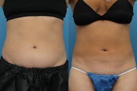Coolsculpting Elite Before & After Gallery - Patient 141201145 - Image 1
