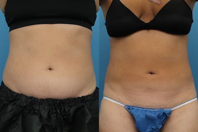 Coolsculpting Before & After Gallery - Patient 141201145 - Image 1