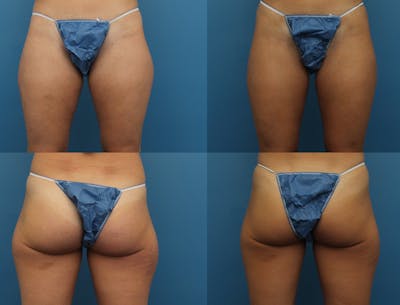 Coolsculpting Elite Before & After Gallery - Patient 141201144 - Image 1