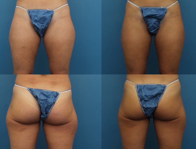 Coolsculpting Elite Before & After Gallery - Patient 141201144 - Image 1