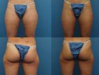 Coolsculpting Gallery - Patient 141201144 - Image 1