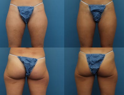 Coolsculpting Before & After Gallery - Patient 141201144 - Image 1