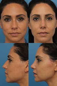 Female Rhinoplasty Before & After Gallery - Patient 142787410 - Image 1