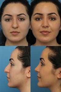 Female Drooping Tip Before & After Gallery - Patient 142815004 - Image 1