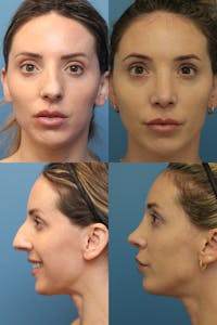 Crooked Nose Before & After Gallery - Patient 143364870 - Image 1