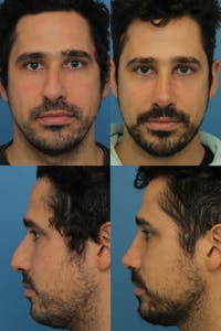 Male Rhinoplasty Before & After Gallery - Patient 144197643 - Image 1