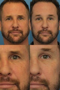 Brow Lift Before & After Gallery - Patient 144459785 - Image 1