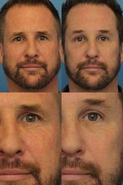 Brow Lift Before & After Gallery - Patient 144459785 - Image 1